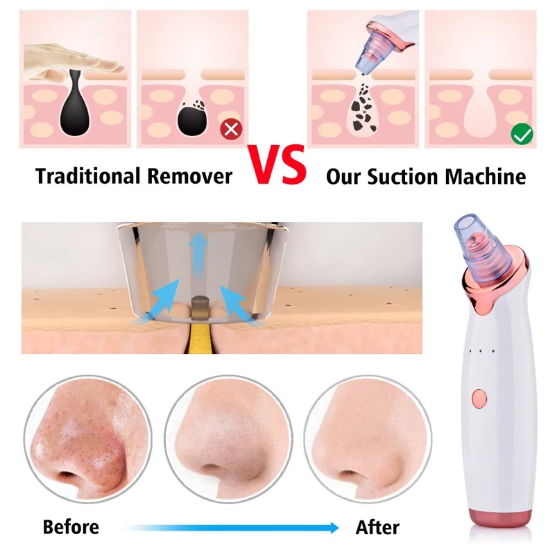 Image de Dispositif de nettoyage des points noirs - Élimination efficace et sans douleur - Unbranded