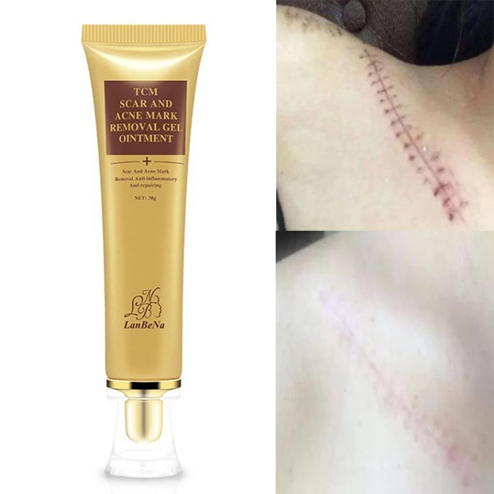 Image de Gel TCM pour Cicatrices et Marques d'Acné - Réduit les Cicatrices et Améliore l'Apparence de la Peau - Unbranded